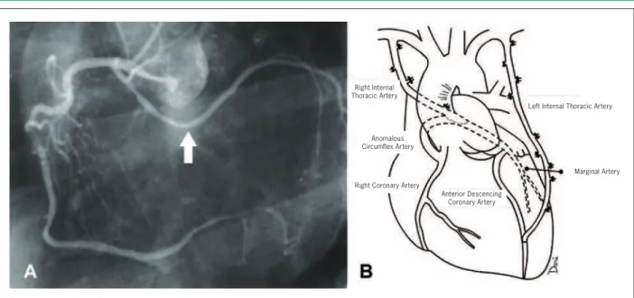 Fig. 1 - Coronary angiography showing the circumflex artery originating from the right coronary artery