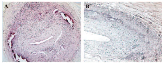 Fig. 1 - A) Temporal artery: intima thickening, diffuse inflammatory infiltrate; calcification foci (HE)