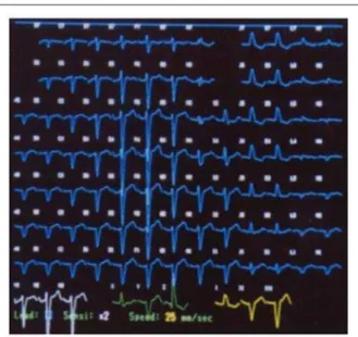 Fig. 1A - PQRST complexes recorded by the 87 Body Surface Potential  Mapping leads.