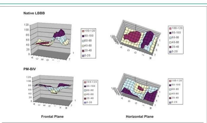Fig. 4 - 3-D graphic representation in the frontal and horizontal planes of the matrixes of mean electrical activation times in the ventricles and in the anteroseptal region  observed in the isochronous maps constructed with values of the LBBB group in two