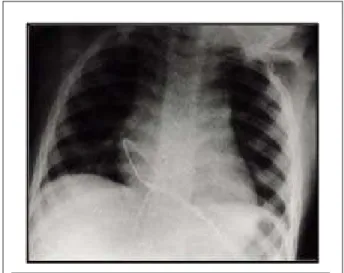 Fig. 1b – Chest radiograph in posterior anterior view showing lead positioning  of the ICD implanted via transatrial transthoracic approach.