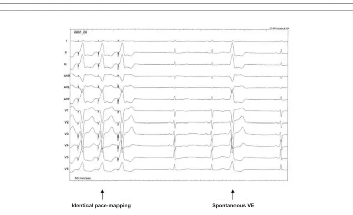 Fig. 3 - An example of an adequate signal obtained during stimulation of the probable point of origin of premature ventricular contractions (PVC)