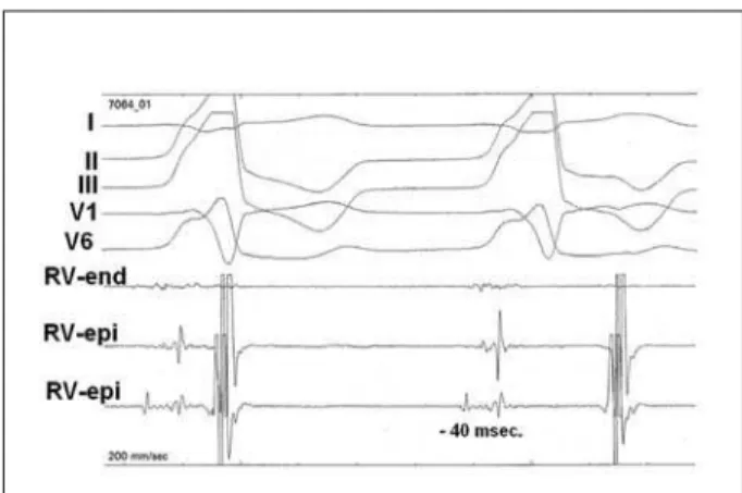 Fig. 7 - An example of RF ablation RVOT-PVC by epicardial mapping technique. 
