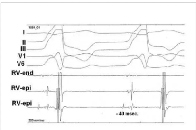 Fig. 7 - An example of RF ablation RVOT-PVC by epicardial mapping technique. 