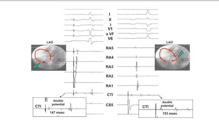 Fig. 1 - Illustration of CTI block: double potential &gt; 100 m at RF application site when stimulating low right atrium and proximal coronary sinus