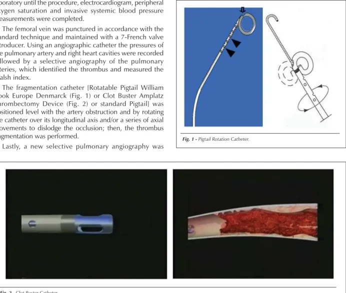 Fig. 1 - Pigtail Rotation Catheter.