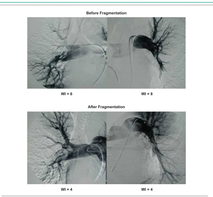 Fig. 4 - Example of a patient in this series. Note the WI improvement in both lungs after PTF.