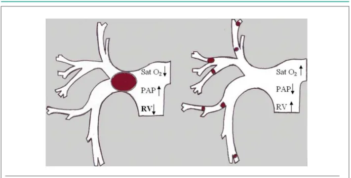 Fig. 5 - PTF Mechanism (transformation of large central embolism into various small thrombi).