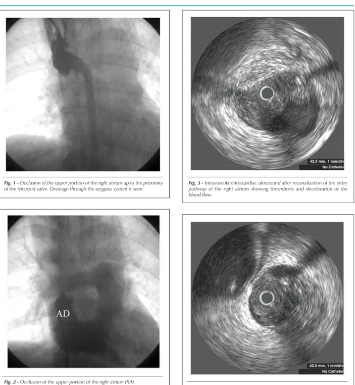 Fig. 1 - Occlusion of the upper portion of the right atrium up to the proximity  of the tricuspid valve