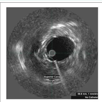 Fig. 9 - Intravascular/intracardiac ultrasound showing maintenance of adequate  apposition of the endoprosthesis and no image of a thrombus on its proximal  edge.