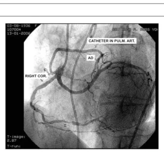 Fig. 3 - Release of the 2.5 x 16mm stent on the target lesion.