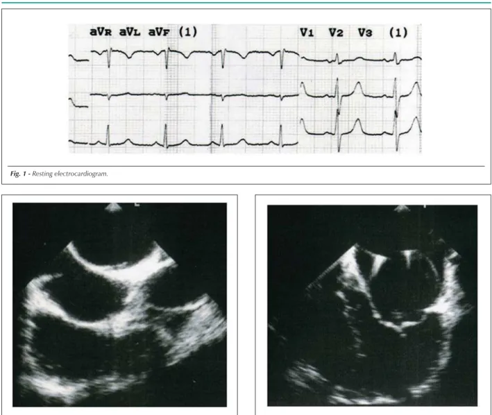 Fig. 1 - Resting electrocardiogram.