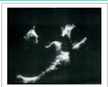 Fig. 5 - Longitudinal two-chamber view: mitral valve with good opening at  the end of the procedure.