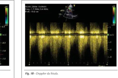 Fig. 1B - Doppler da fístula. 