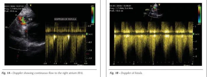Fig. 1A - Doppler showing continuous flow to the right atrium (RA).