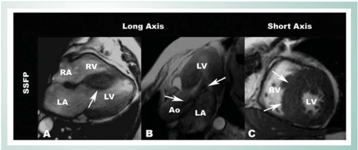 Fig. 1 - A Patient example with classic pattern of hypertrophic cardiomyopathy. Panel A shows a four chamber long axis view with a classic asymmetric septal  hypertrophy (arrow)