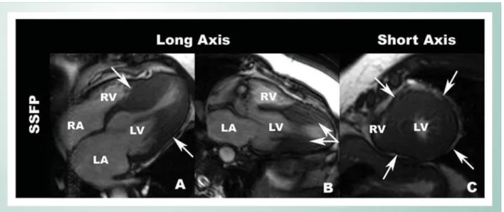 Fig. 3 - A Patient example with hypertrophic cardiomyopathy. Panels A and B. In the long axis views, there is isolated mid regional hypertrophy of left ventricular  (arrows)