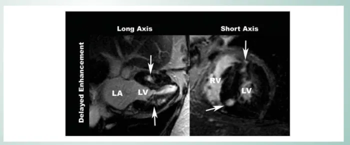 Fig. 6 - A Patient example with hypertrophic cardiomyopathy. Long (left) and short (right) axis view with multiple foci myocardial delayed enhancement with confluent  pattern