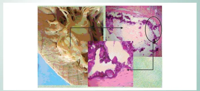 Fig. 1 - A. Heart Macroscopy: ischemic area that impairs mural endocardium and myocardium