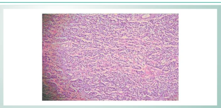 Fig. 3 - Kidney Microscopy: atrophy and segmental glomerular fibrosis. Bowman capsule thickening