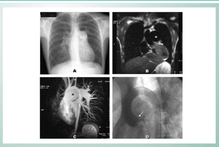 Fig. 1 - (pre-operative) - Aneurysmal dilation of PAT demonstrated by thorax X-Ray (A), CAT scan (B), and magnetic angioresonance (C); (D) Hemodynamic study: 