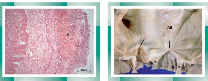Fig. 2 - Corte histológico do intestino delgado evidenciando necrose  hemorrágica da mucosa (asterisco)