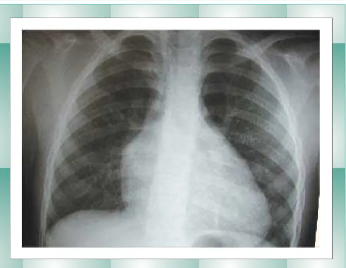 Fig. 1 - Radiografia de tórax mostra a trama vascular pulmonar diminuída em presença de aumento das cavidades direitas
