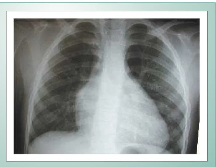 Fig. 1 - Radiografia de tórax mostra a trama vascular pulmonar diminuída em presença de aumento das cavidades direitas