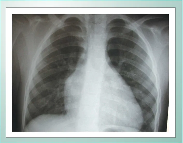 Fig. 1 - Chest X-ray showing the diminished pulmonary vascularity in the presence of enlarged right cavities