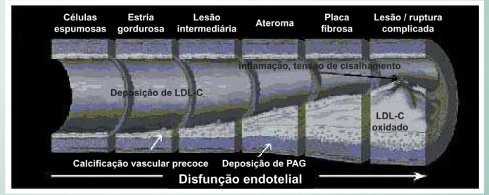 Fig. 5 - Pocessos relacionados com aceleração da doença coronariana e ruptura da placa em pacientes com doença renal
