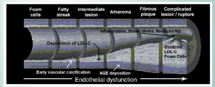 Fig. 5 - The processes related to the acceleration of coronary disease and plaque rupture in patients with renal disease