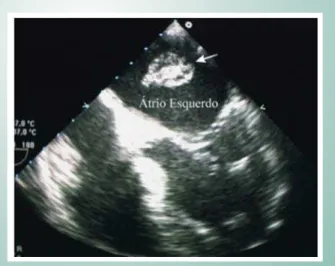 Fig. 1 - Myxoma in the left atrium in a two-dimensional image of  transesophageal echocardiography.