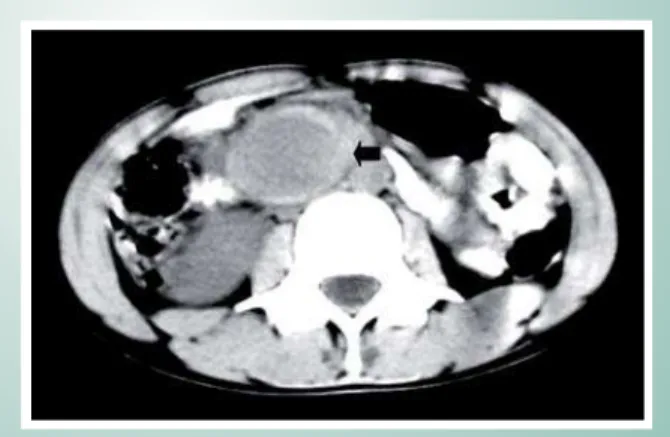 Fig. 1 - Abdominal CT showing a hypodense image in the superior  mesenteric artery consistent with aneurysm