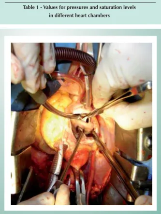 Fig. 1 - Foramen ovale seen transoperatively.