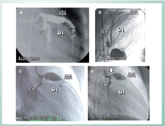 Fig. 1 - Giant diffuse left coronary artery aneurysms (1A) with a clear involution some months later (1B),  albeit showing a residual giant aneurysm at the anterior  descending artery (1C), which decreased progressively until 16 months following the initia