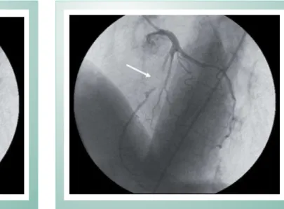 Fig. 1 - End diastolic left coronary angiogram (LAO 45; CRAN 25). The  white arrowhead indicates a angiographic normal mid LAD segment.