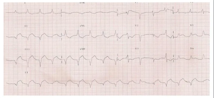 Fig. 2 - Electrocardiogram (ECG) - Accelerated idioventricular rhythm with no P wave, ST–segment elevation in inferolateral walls