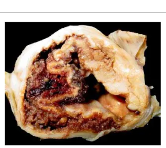 Fig. 6 - Histological section of myocardium with ischemic necrosis in contraction  bands (some necrotic cells are indicated by arrows)