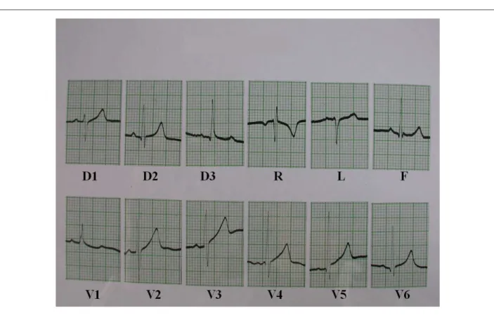 Fig. 2 - Eletrocardiograma salientando sinais de discreta sobrecarga de ventrículo direito.