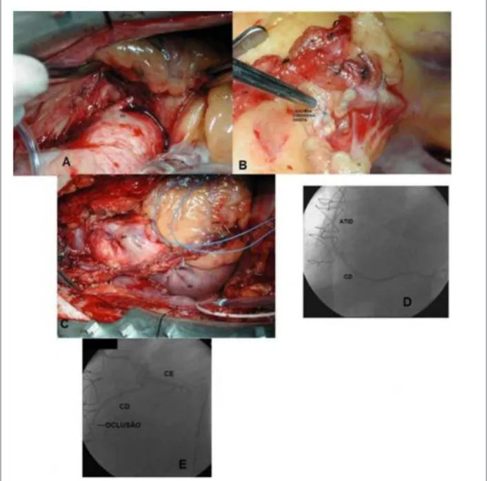 Fig. 2 - A – Intraoperative image showing the anomalous origin of the right coronary arising from a single ostium (left coronary ostium)