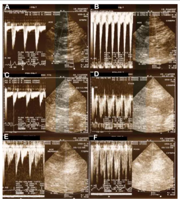 Figure 1 - Doppler Echocardiography of LITA showing the flow pattern during different situations: A – In situ LITA at rest., B – In situ LITA under dobutamine  stress., C – LITA in a simple graft at rest., D – LITA in a simple graft under dobutamine stress