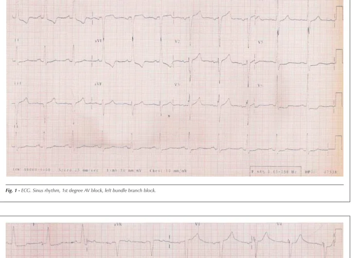 Fig. 1 - ECG. Sinus rhythm, 1st degree AV block, left bundle branch block.