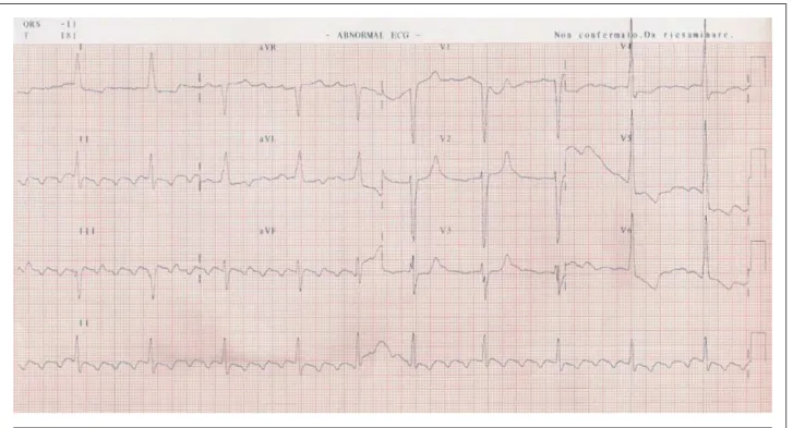 Fig. 3 - ECG. Atrial flutter with advanced 5:1 atrioventricular block and left bundle branch block.