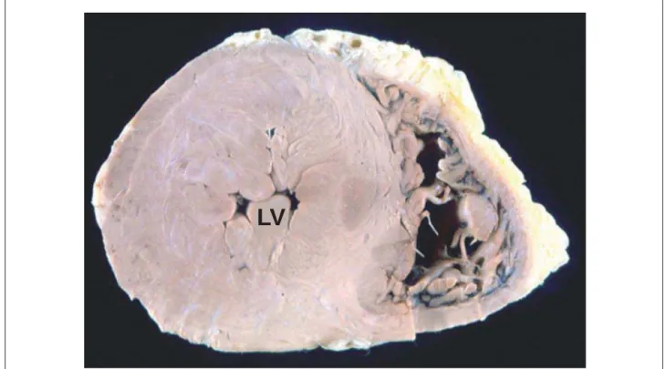 Fig. 4 - Cross-section of the ventricles showing hypertrophy of the left ventricle (LV), with reduced cavity volume (concentric hypertrophy).