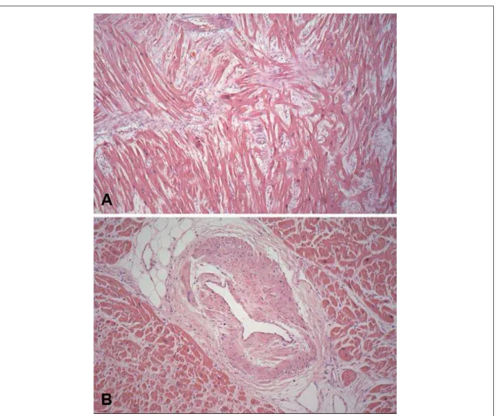 Fig. 6 - Histological aspects of the left ventricular myocardium. Hypertrophy of the cardiomyocytes, with evident disorganization of these cells, fine interstitial fibrosis  (A) and marked thickening of the intramural coronary arteriolar wall (B)