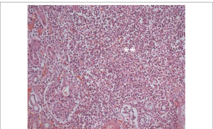 Fig. 7 - Histological section of the left kidney showing neutrophilic inflammatory infiltrate interstitially and permeating tubules, with formation of microabscesses (double  asterisk)