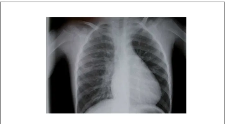 Fig. 2 - Echocardiogram showing the large ostium secundum atrial septal defect (ASD) in a subcostal view (A), and a left-to-right shunt on color flow mapping in the  apical four-chamber view (B)