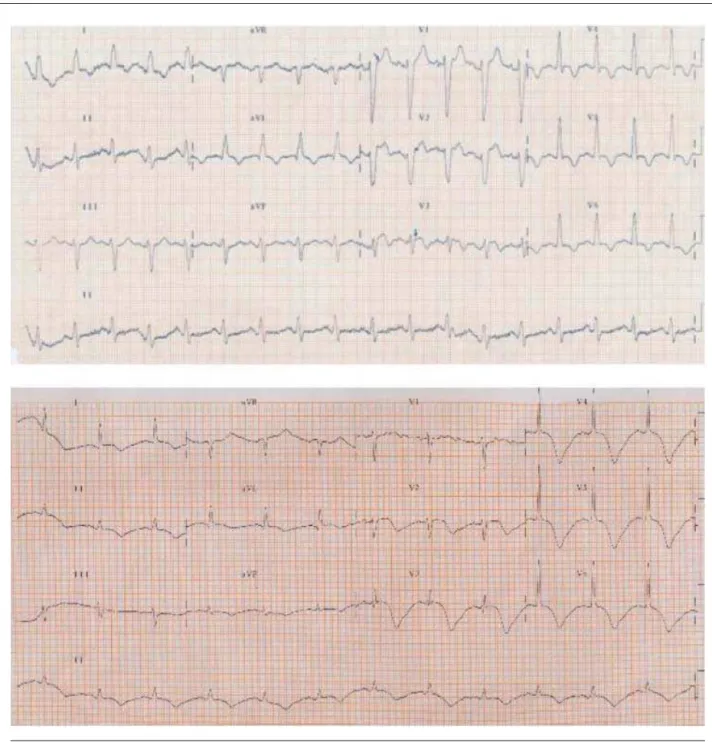 Fig. 1 - 12-derivation ECGs obtained at the hospital admission in the emergency room (upper panel) and 24 hrs later (lower panel)