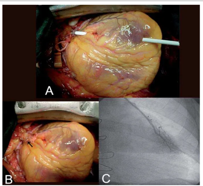 Fig. 1 - A – Criação de túnel na parede livre do ventrículo esquerdo, paralelo a artéria interventricular anterior, utilizando bainha de introdutor 10 French (procedimento  modificado pelo autor); B – Porção terminal esqueletizada da artéria torácica inter