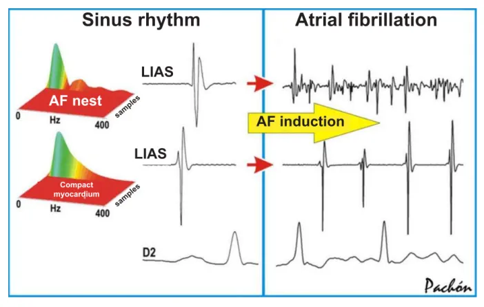 Fig. 4 - The AF nests identified during the sinus rhythm by spectral mapping show a very different behavior when compared to the compact myocardium during AF